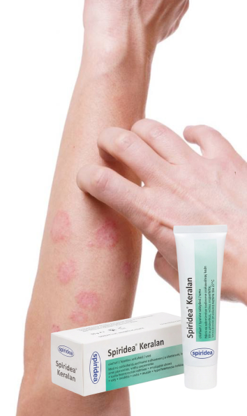 Atopická dermatitída