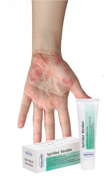 Psoriáza